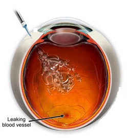 Intravitreal injection
